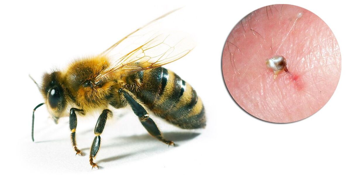 Hondrostrong enthält Bienengift, das die Stoffwechselprozesse im Gewebe verbessert