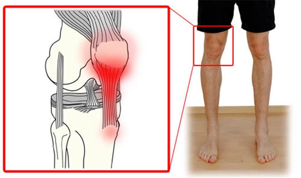 Tendinitis - Entzündung der Sehnen im Kniegelenk