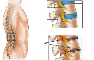 Ursachen der Osteochondrose der Lendenwirbelsäule