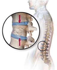 Osteoporose verursacht Rückenschmerzen im Lendenbereich